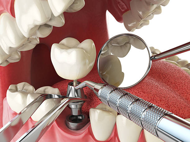Best Emergency Dental Care for Broken or Chipped Teeth in Columbia, IL